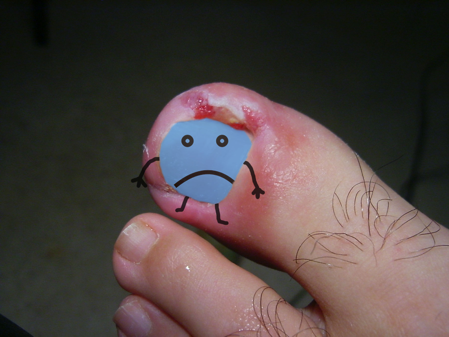 You are currently viewing The Ingrown Nail – What to do
