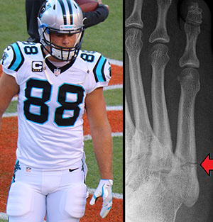 You are currently viewing Understanding Greg Olsen’s Foot Injury – The Infamous Jones Fracture