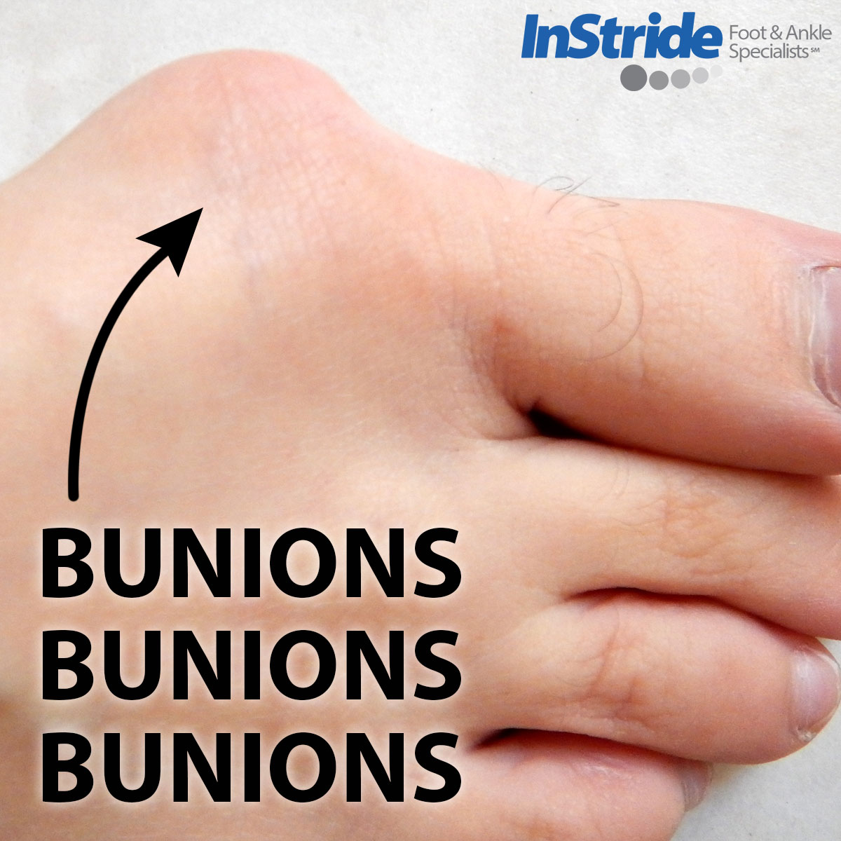Read more about the article Bunions Bunions Bunions & Same Day Surgery