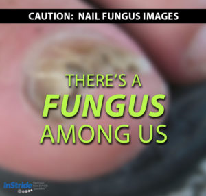 Read more about the article There’s a fungus among us – and it’s on your toes